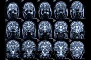 alteplase - ischaemic strokes 