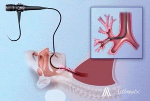 Bronchial Thermoplasty System
